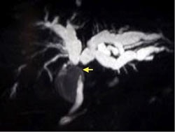 MRCP picture showing hepatic ducts.
