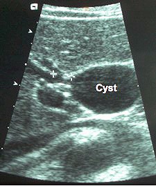 Ultrasound picture of a choledochal cyst