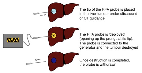 RFA diagram