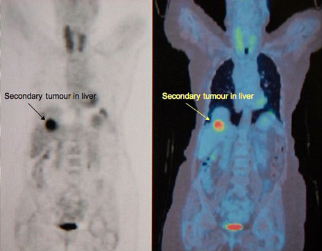FDG PET scan picture showing a secondary tumour deposit in the liver