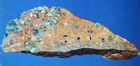 Section through a cirrhotic liver shows the nodular appearance of the organ and multiple bluish foci of primary liver cancer
