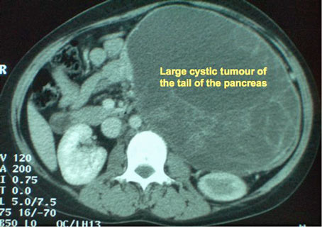 CT scan showing a large cystic tumour